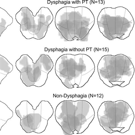 Topographical Distributions Of Midbrain And Pontine Lesions In Patients Download Scientific