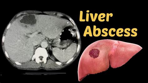 Liver Abscess Cect Abdomen Radiology Youtube