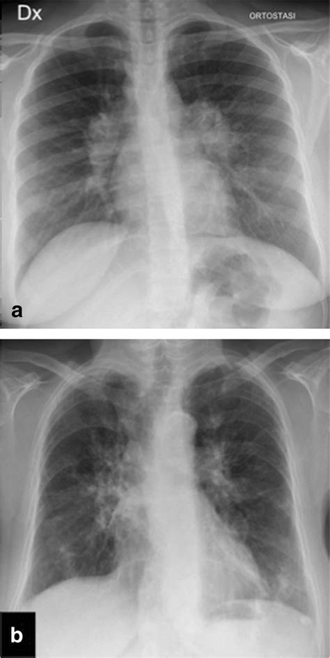 A B Postero Anterior Chest Radiograph In A Patient With Sarcoidosis A