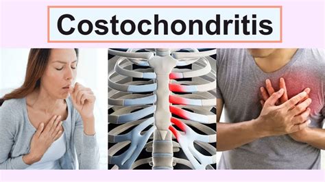 Costochondritis Youtube