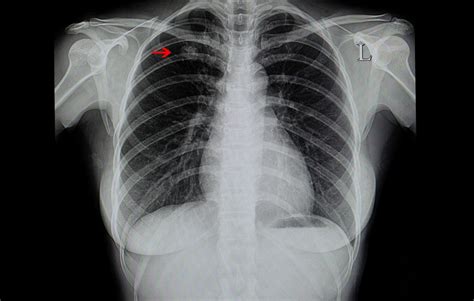 An Efficient, Minimally Invasive Pathway to Manage Suspicious Lung ...