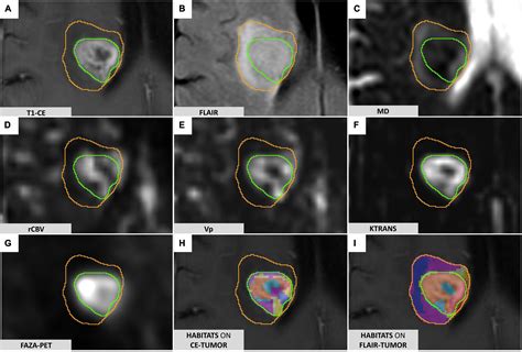 Decoding The Heterogeneity Of Malignant Gliomas By Pet And Mri For