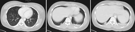 Non Operative Management Of Blunt Splenic Injury Radiology Cases