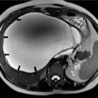 Ultrasound scan of the huge liver cyst. Figure 2. MRI demonstrating the ...