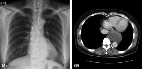 Chest X‐ray Showed Mediastinal Mass In Posterior Cardia Area A The