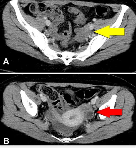 A Post Surgery Contrast Enhanced Ct Scan Axial Image Showed Bulky Download Scientific Diagram