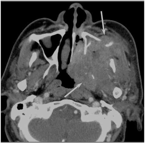 JCM Free Full Text Imaging Characteristics Of Malignant Sinonasal