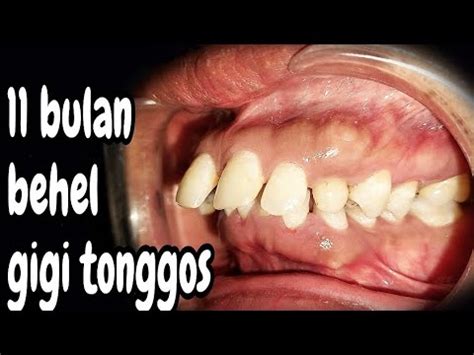 11 Bulan Perawatan Behel Gigi Tonggos Cara Behel Gigi Maju Behel