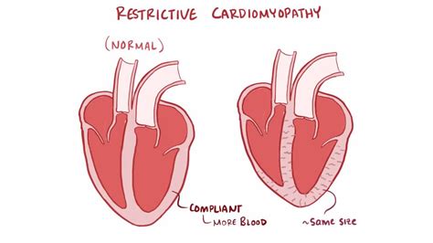 Restrictive Cardiomyopathy Video Anatomy Definition Osmosis