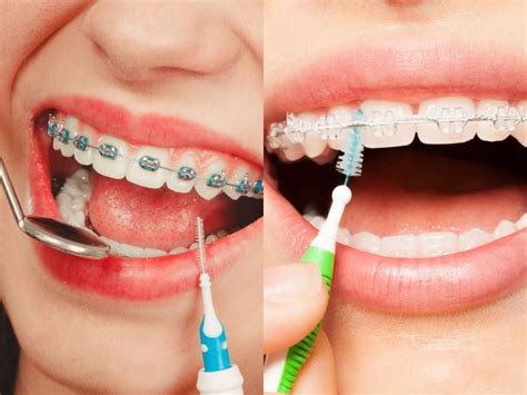 Ceramic Braces Vs Metal Braces Which Is Right For You