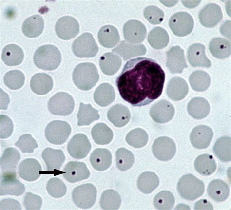 Ehrlichia Usmle Strike