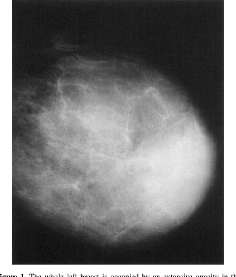 Figure From Scintimammographic Findings Of Phyllodes Tumor Of The