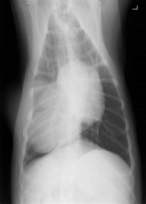 Bone Tumors Rib — Dr Julius M Liptak