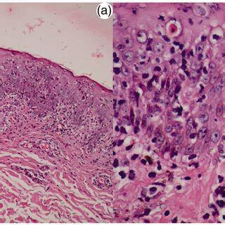 Histopathology Of Skin Biopsy Showing Epidermal Mild Hyperplasia And