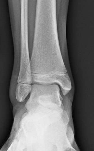 Epiphyseal Fracture X Ray