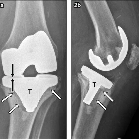 A Anteroposterior And B Lateral Left Knee Radiographs In A Download Scientific Diagram