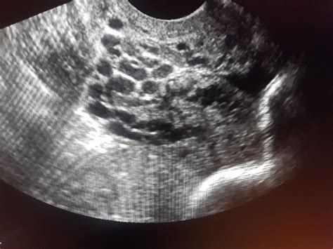 Pelvic varices | Ultrasound, Sonography, Celestial