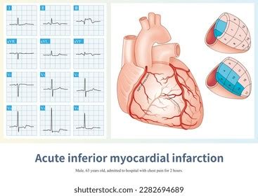 Inferior Infarct Images Stock Photos Vectors Shutterstock