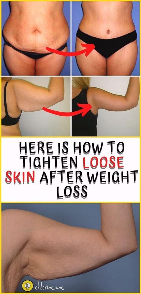 How To Tighten Loose Skin Tighten Loose Skin Loose Skin Saggy Skin