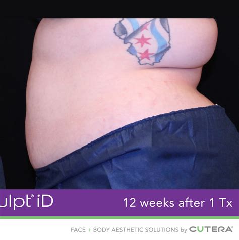 Trusculpt Id Woodland Hills Fat Reduction Elleve Med Spa