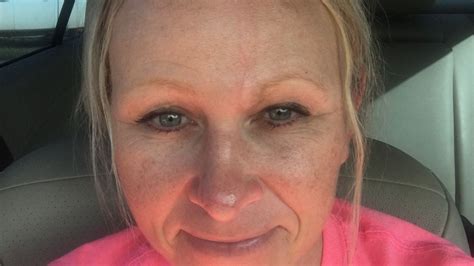 Mum Who Used Sunbeds Up To Six Times A Week Left With Hole In Her Nose