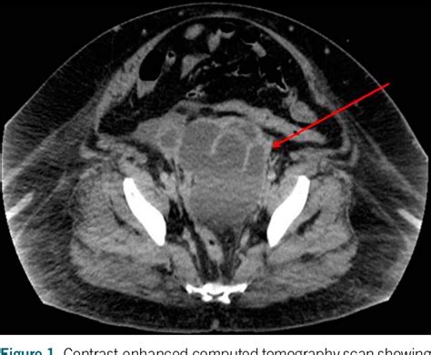 Figure 1 From Transrectal Endoscopic Ultrasound Guided Drainage Of A