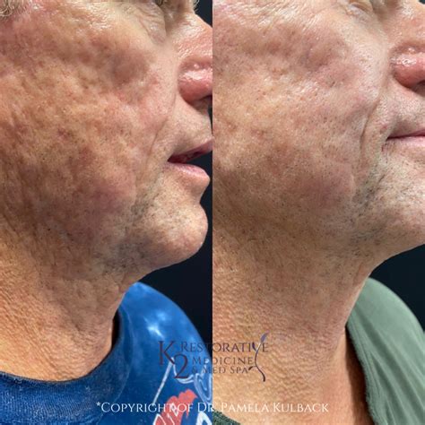 Morpheus 8 + CoolPeel Equals Oh WOW! | Dr. Pamela Kulback