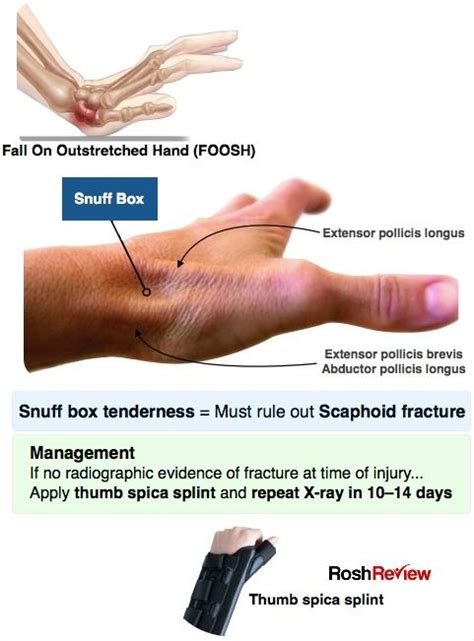 Snuff Box Tenderness, Scaphoid Fracture | Medical knowledge, Medical ...