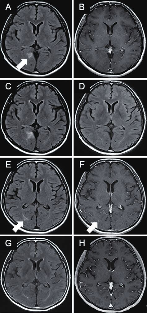 Mri Of Intracranial Lesions Fluid Attenuated Inversion Recovery Image