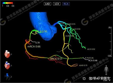 高尚医学影像之冠状动脉ct血流储备分数ai定量分析（ct Ffr） 知乎