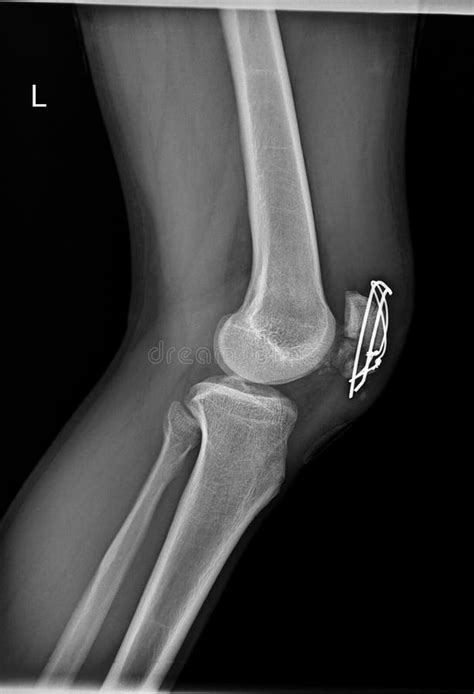 Patella Fracture