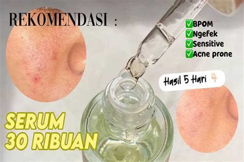 Top 5 Serum Atasi Jerawat Terbaik Untuk Kulit Berminyak Lengkap Dengan