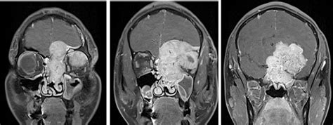 Sinonasal hemangiopericytoma – Radiology Cases