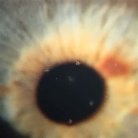 Filamentary keratitis -the most severe clinical case of the study ...