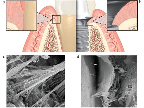 How Dental Hygienists Can Manage Peri Implantitis Patients Registered Dental Hygienists