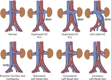 Inferior Vena Cava Thrombosis Jacc Cardiovascular Interventions