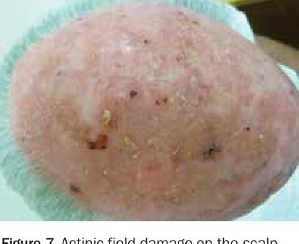 Figure 1 From A GPs Guide To Actinic Keratosis Semantic Scholar