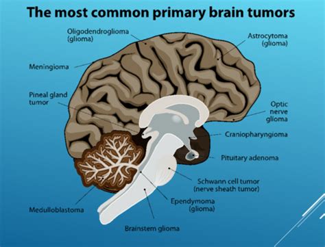 Brain Tumors General And Primary Tumors Flashcards Quizlet