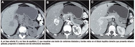 Lesiones Benignas Localizadas En El H Gado Desde La Mirada De Las Im Genes