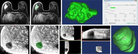 Breast Cancer Research And Treatment Reconstruction Of Unilateral