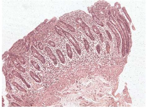 Biopsy Picture Showing Atrophy Of The Duodenal Villi Mild