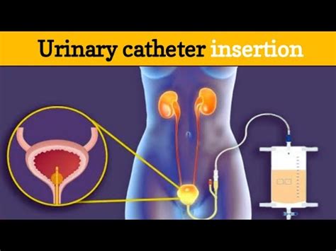 Folley Catheter Insertion And Uses In Human How To Insert Catheter In