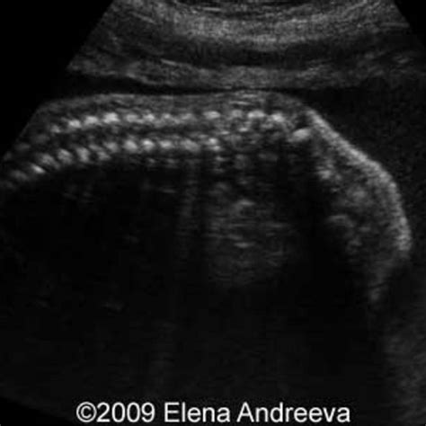 📃 Caudal Regression Syndrome