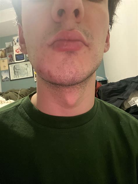 Jaw Cystgrowth Rdermatologyquestions