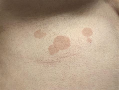 Discolored Spots Around Breasts That Have Come And Gone And Changed