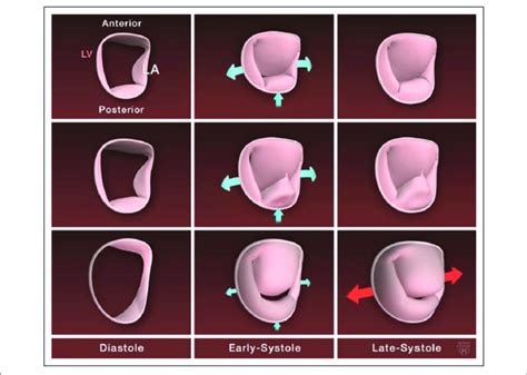 | Mitral annulus dynamic in normal mitral valve and by degenerative... | Download Scientific Diagram