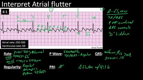 Basic Arrhythmia Practice Strips Lesson Youtube