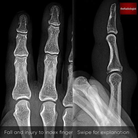 Volar Plate Avulsion Fracture X Ray View