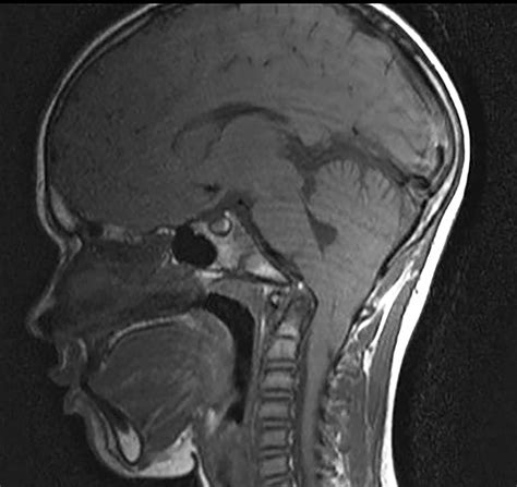 Better Understanding of Chiari Malformation - Johns Hopkins Medicine