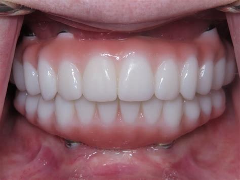 Hybrid Implant Dentures: First Impression Dental Fresno: General Dentists